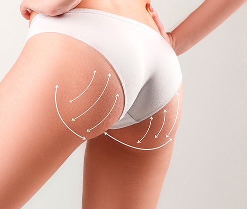 ¡Plasma Gel para Glúteos Perfectos! Agenda Tu Valoración Sin Costo en Bogotá