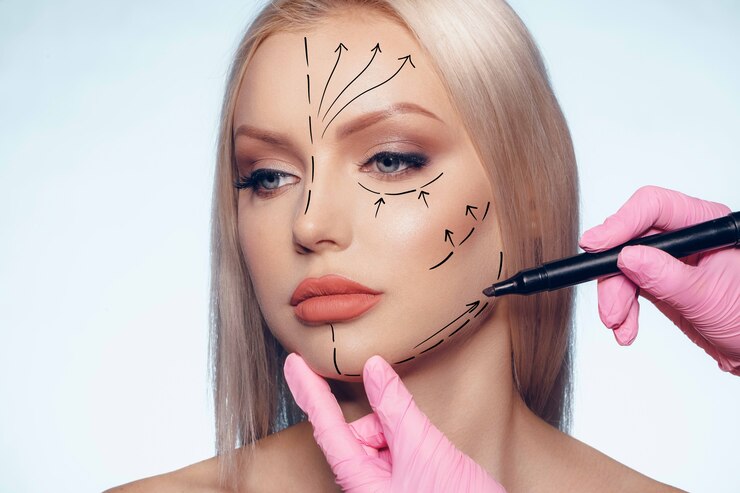 Lifting Facial con Hilos Tensores